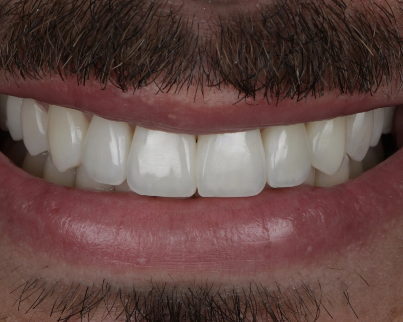 Detalle clínico real de dientes anteriores, trabajo de Ana Luiza Libório