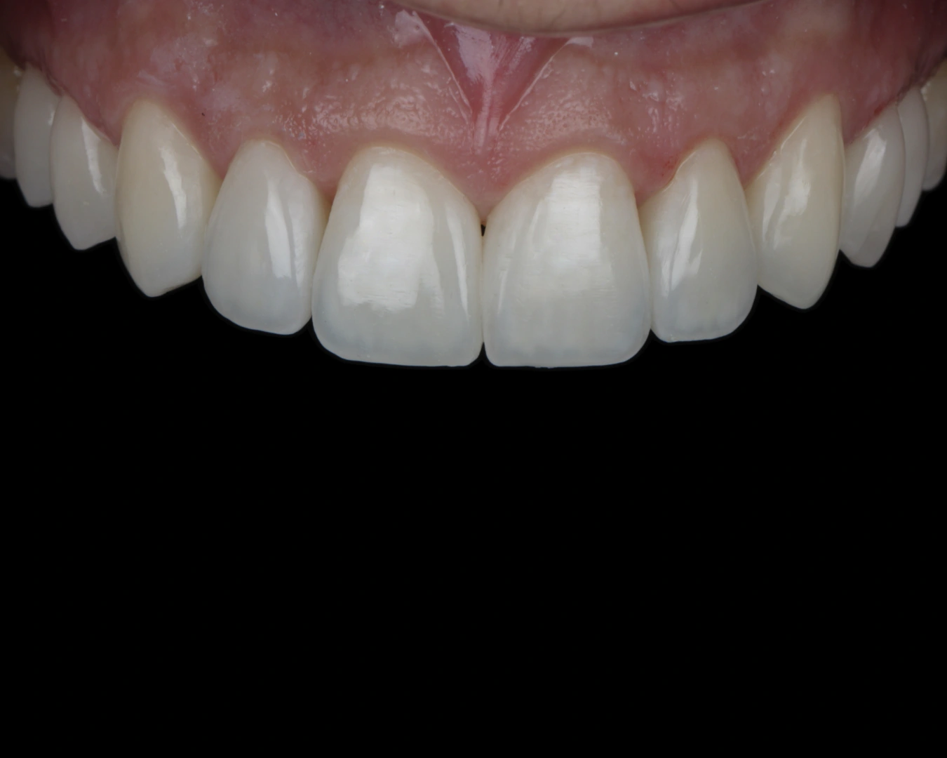 Vista frontal de un resultado clínico real de los dientes anteriores