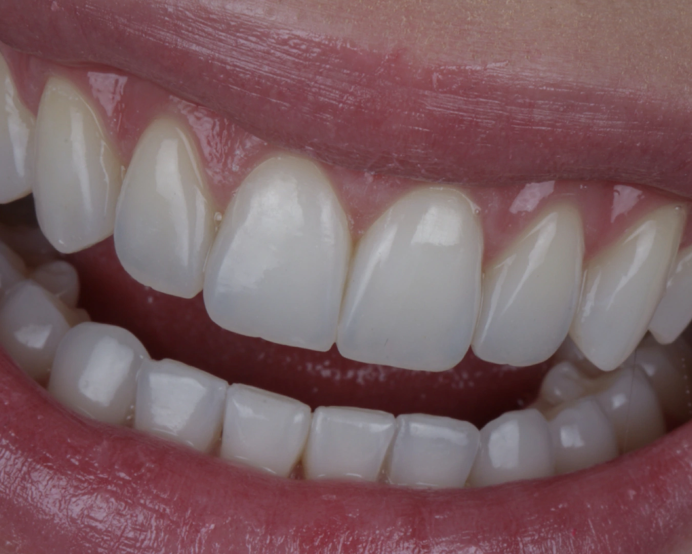 Detalle real de una sonrisa, con la superficie de los dientes visible