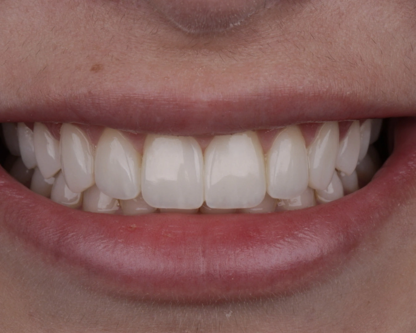Fotografía real de una sonrisa y de los dientes anteriores, trabajo clínico de Ana Luiza Libório