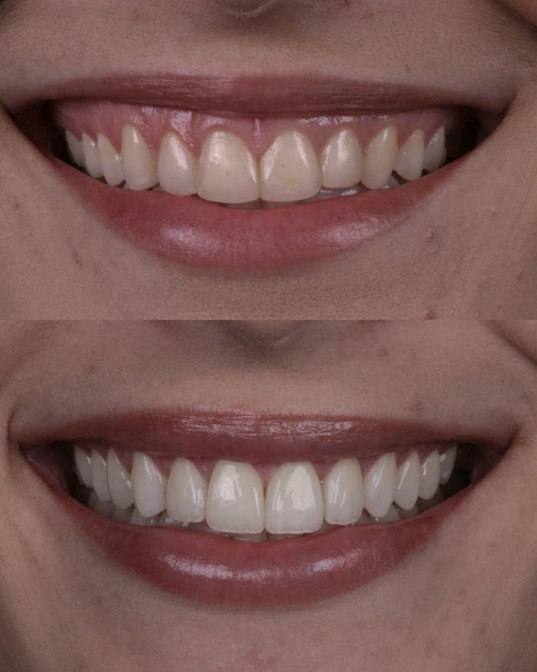 Comparativo clínico original con las fotografías de antes y después, caso 2